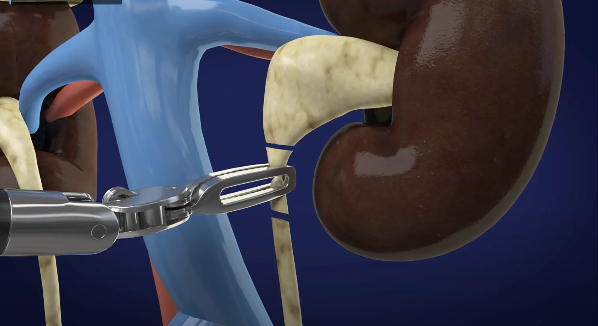 Ilustração cirurgia robótica: rim e ureter